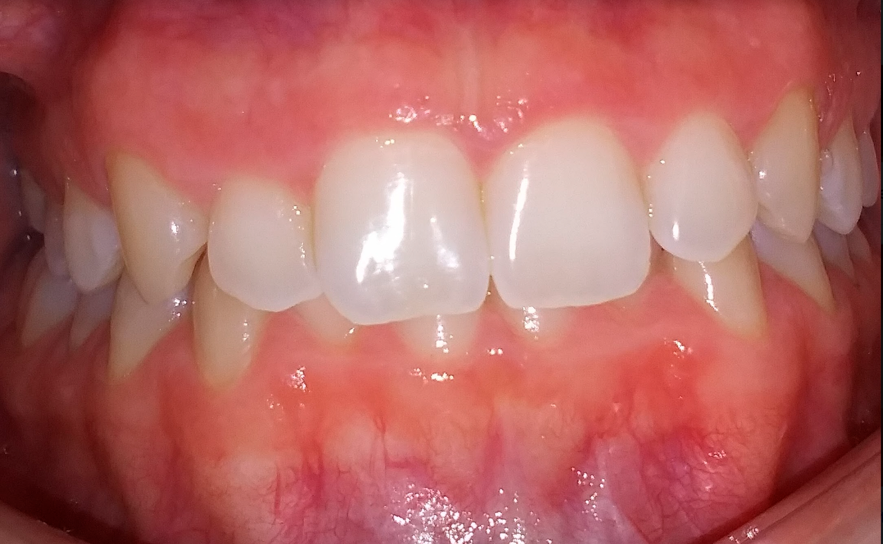 Mouth showing vertical malocclusion