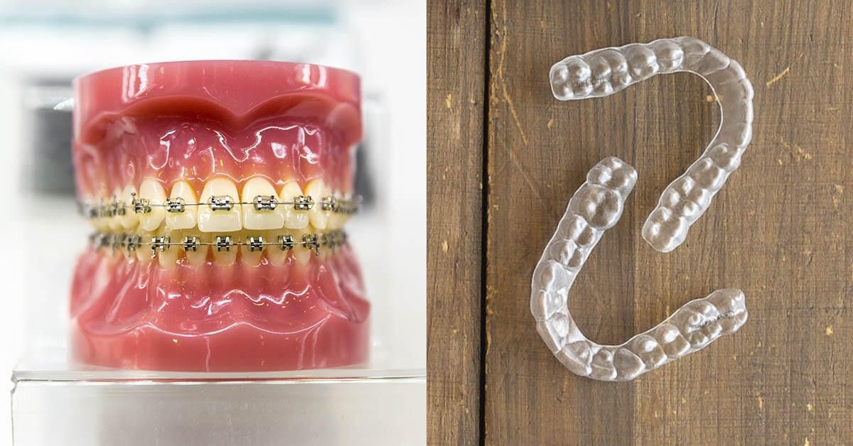 Removable orthodontics Definition, advantages & prices 🦷