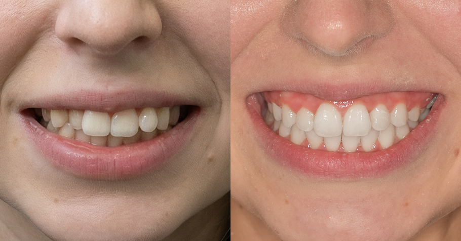 Close-up foto van een patiënt&nbsp;van een voor en na foto met aligners van impress