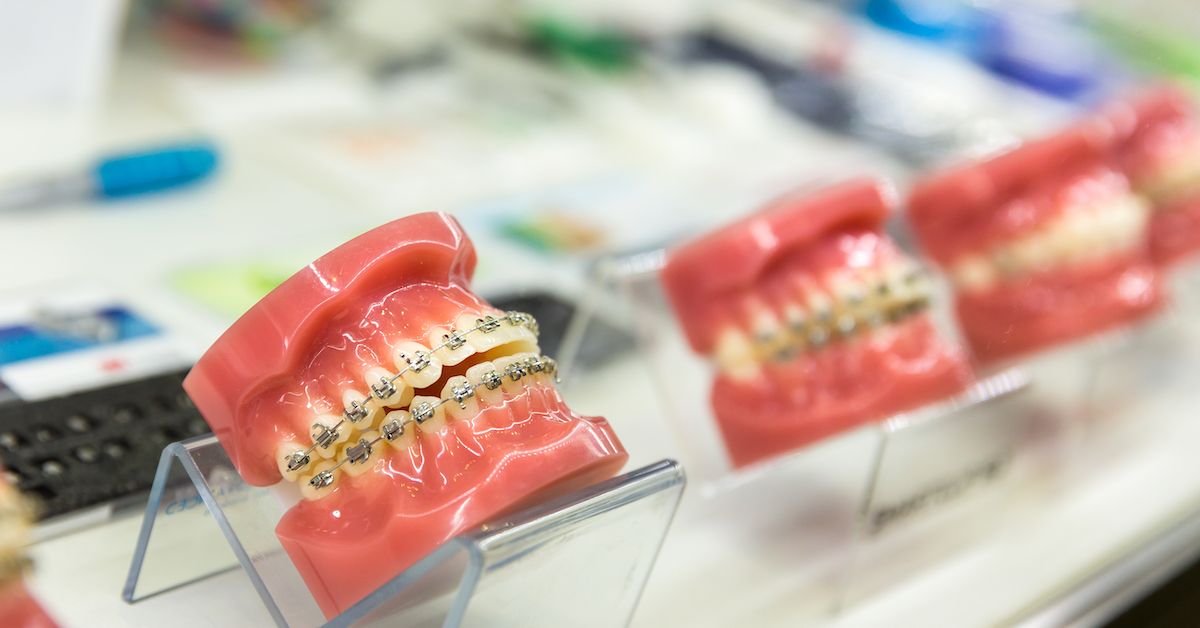 ¿Cuánto cuestan los brackets? Precios en España 2024 🦷