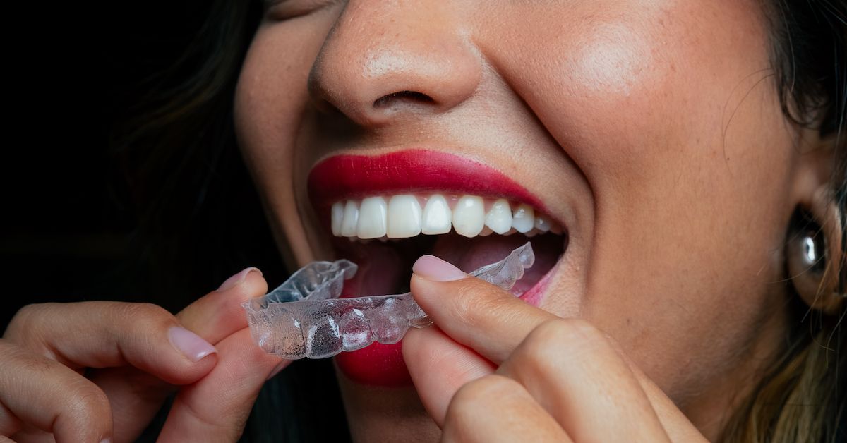 Una boca de mujer con los labios pintados de rojo que se mete un alineador en la boca.