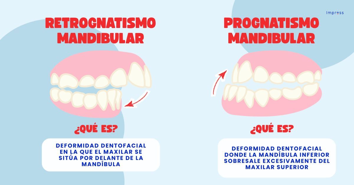 Infografía sobre retrognatismo mandibular y prognatismo mandibular.