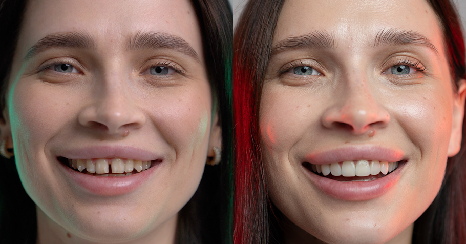 een voor en na foto van diastema met aligner