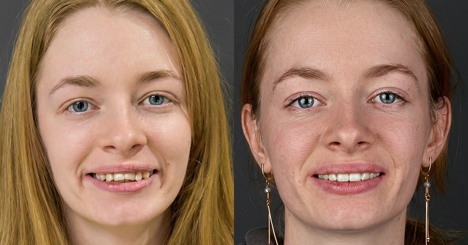 voor en na foto van open beet met aligners