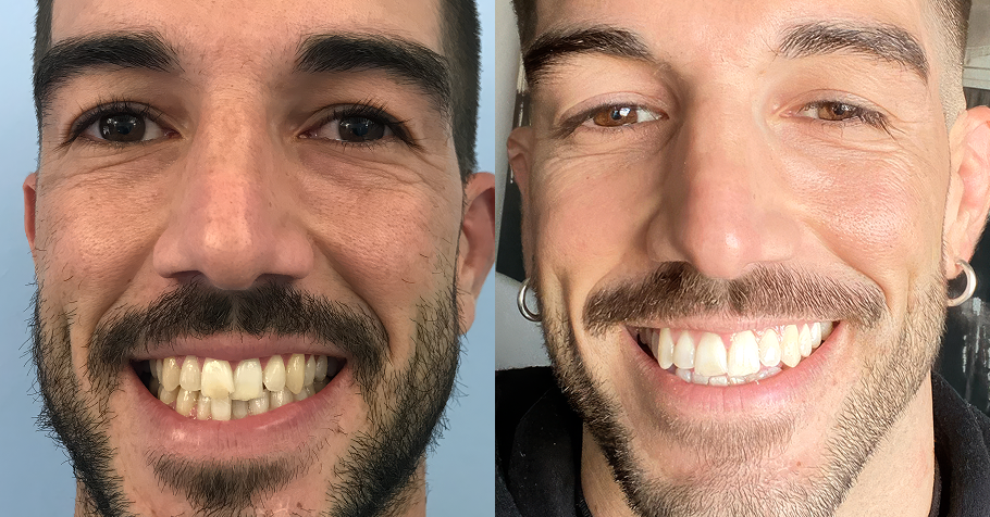 voor en na foto van kruisbeet met aligners