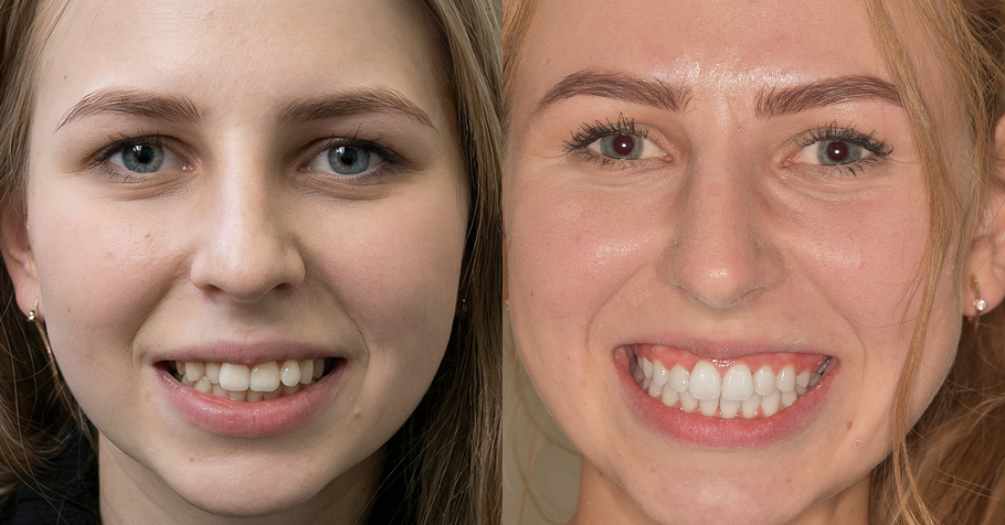 voor en na foto van overbeet met aligners