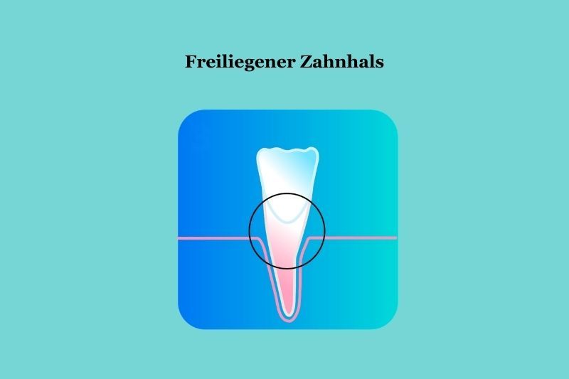 Grafik von einem einzelnen Zahn auf dem der Zahnhals markiert ist