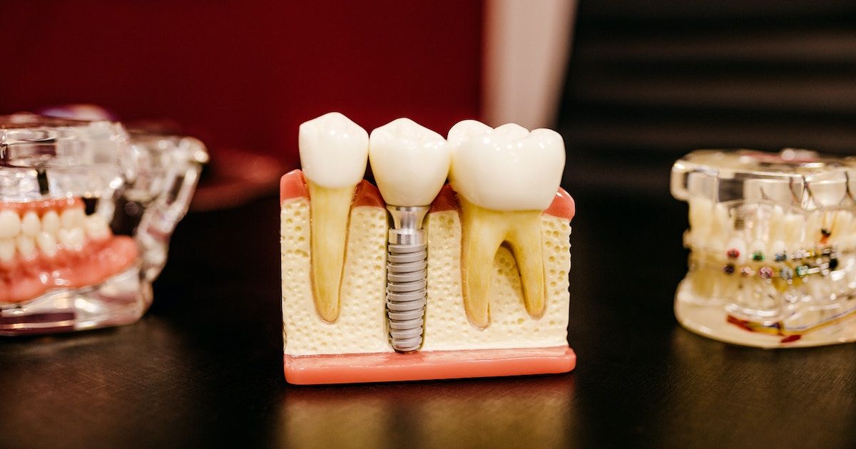 Implantes Dentales Tipos De Implantes Dentales Y Precios implantes-dentales-tipos-de-implantes-dentales-y-precios