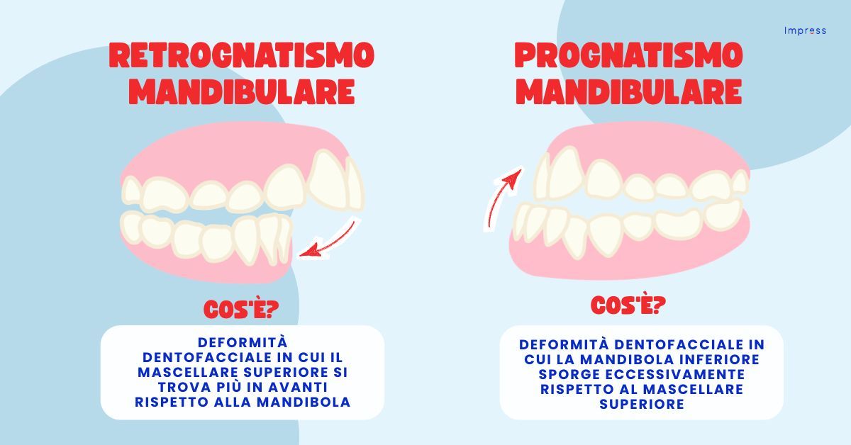 Infografica sul retrognatismo mandibolare.