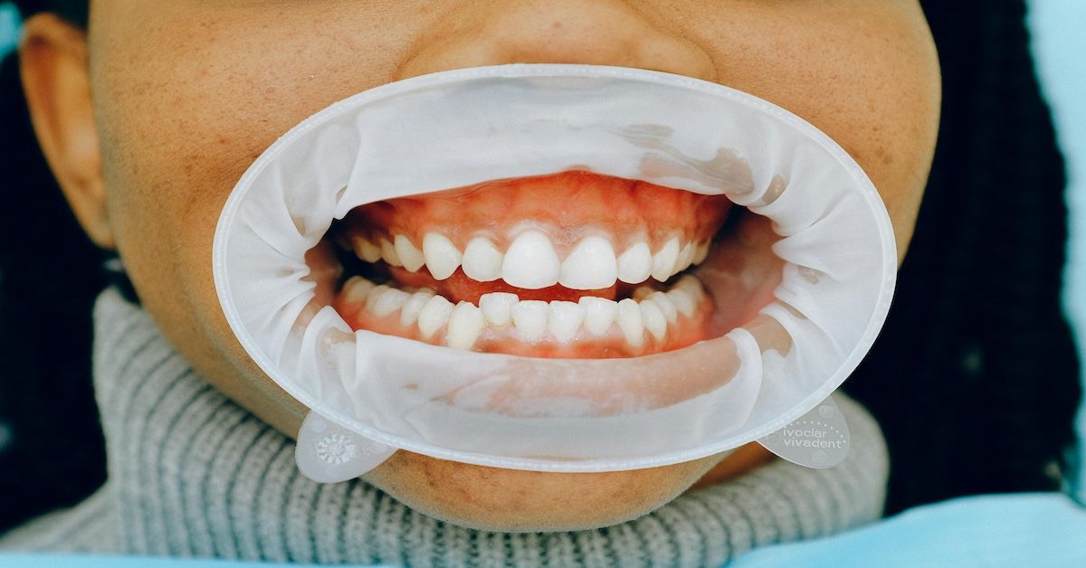 Un patient dentaire portant un écarteur de joues montre ses dents, qui sont légèrement de travers.