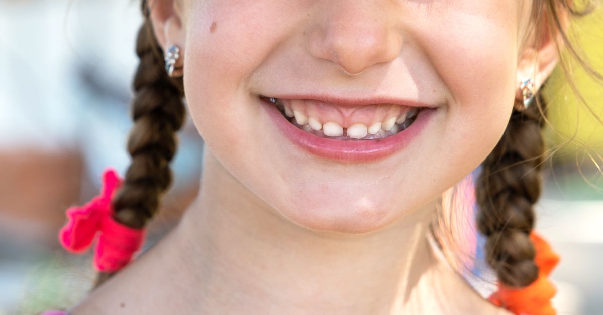 Mädchen mit Gummy Smile lächelt.
