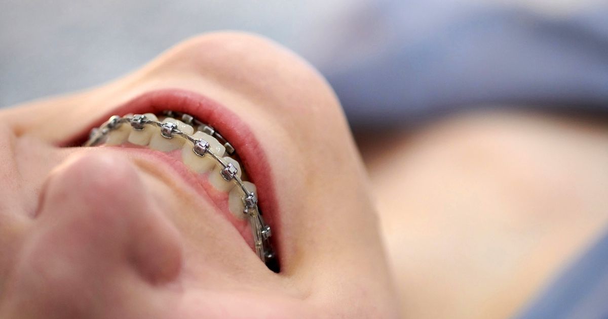 Nahaufnahme eines Mädchens mit Metallbrackets.
