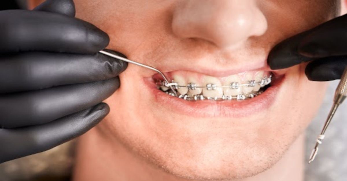 Junger Mann mit Zahnspange und intermaxillären Gummizügen.