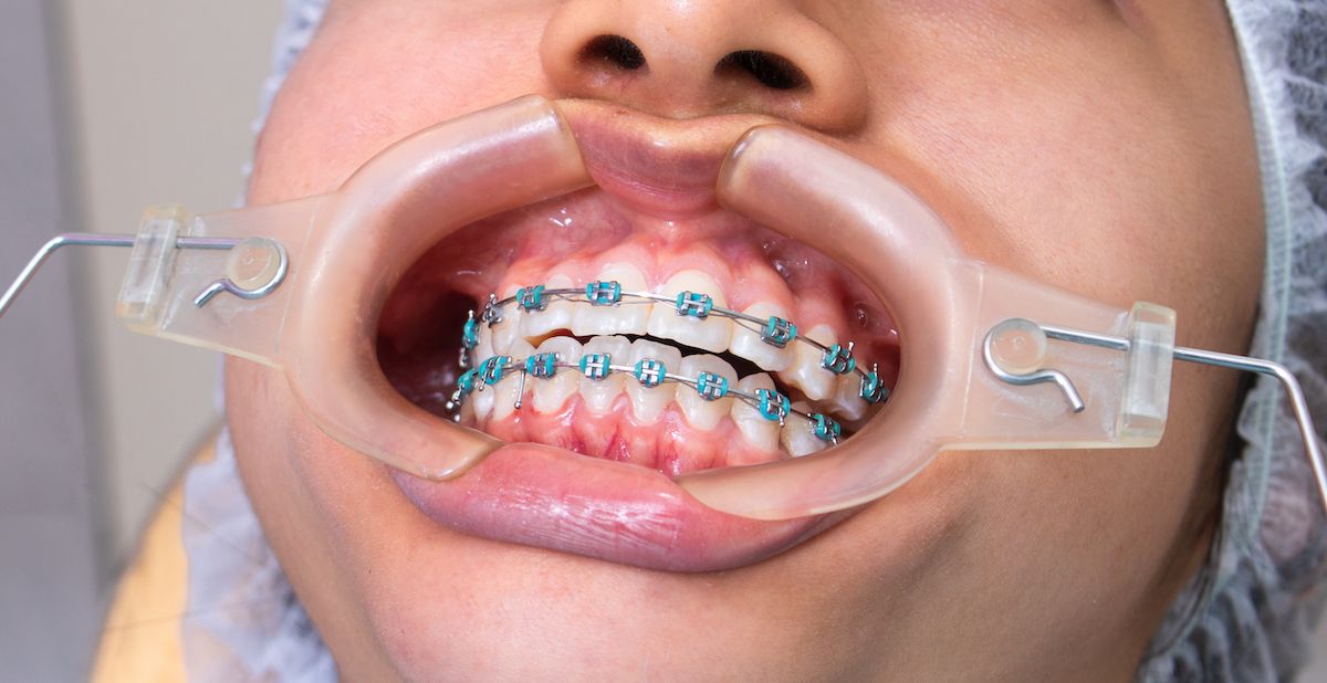 Junge Person mit Mundöffner beim Zahnarzt mit Metallbrackets.