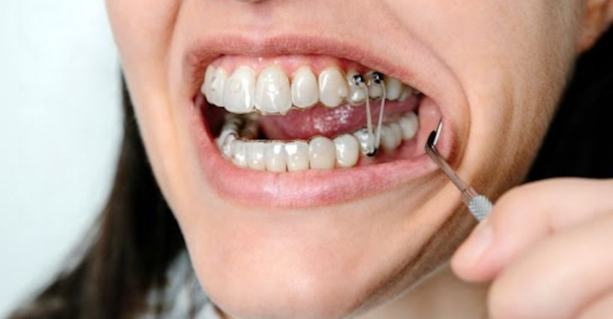 Meisje met beugels die een intermaxillaire rubberband aanbrengt.&nbsp;