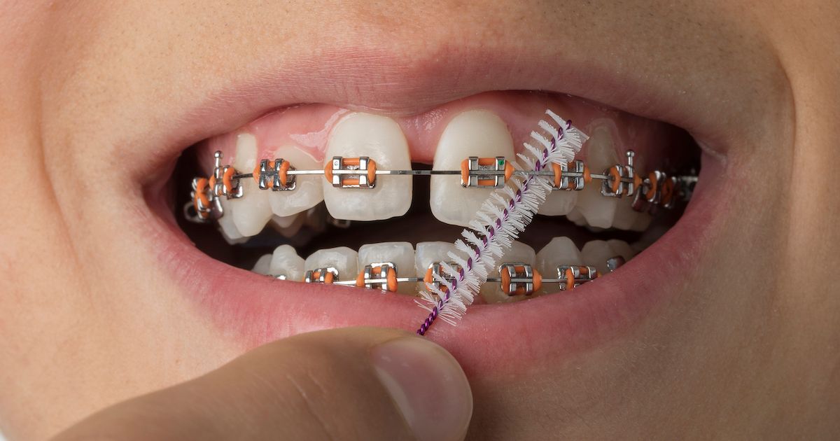 Eine junge Frau führt eine Interdentalbürste zwischen ihren Metallbrackets hindurch.