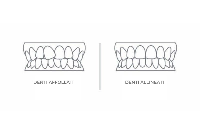 Infografica differenza denti affollati e denti dritti