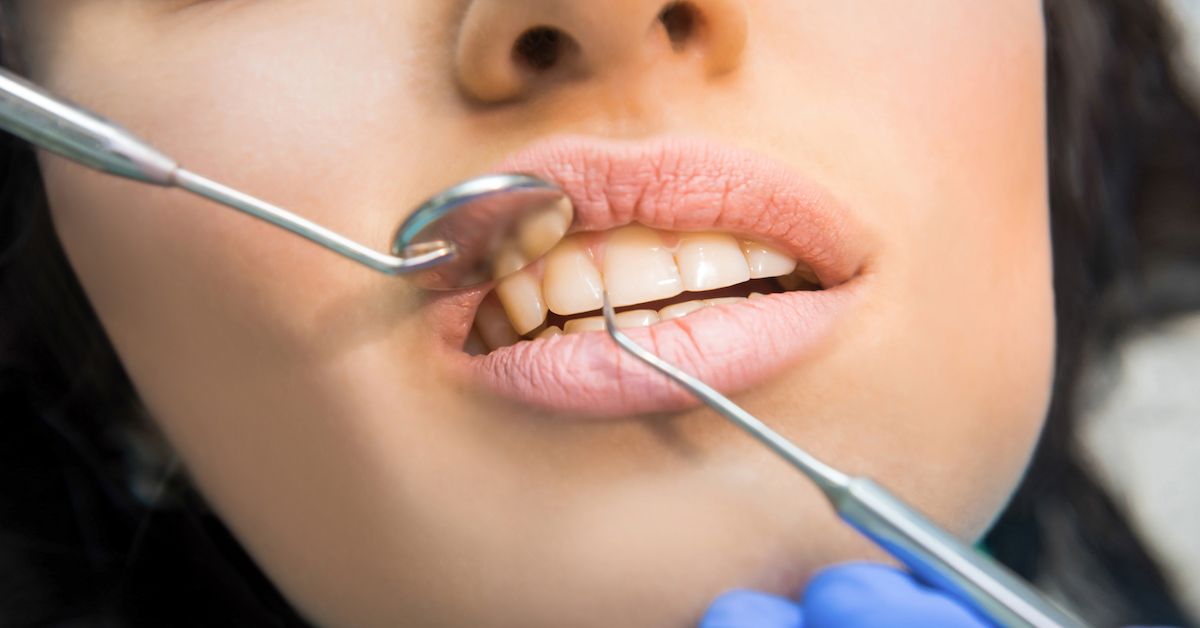 Gingivitis Symptoms and treatment of swollen gums 🦷