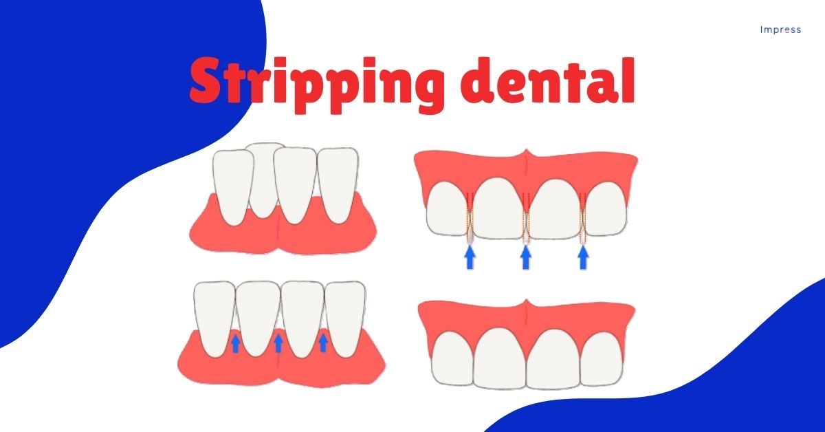 Infografía de unos dientes antes y después del stripping dental o IPR y su alineación.