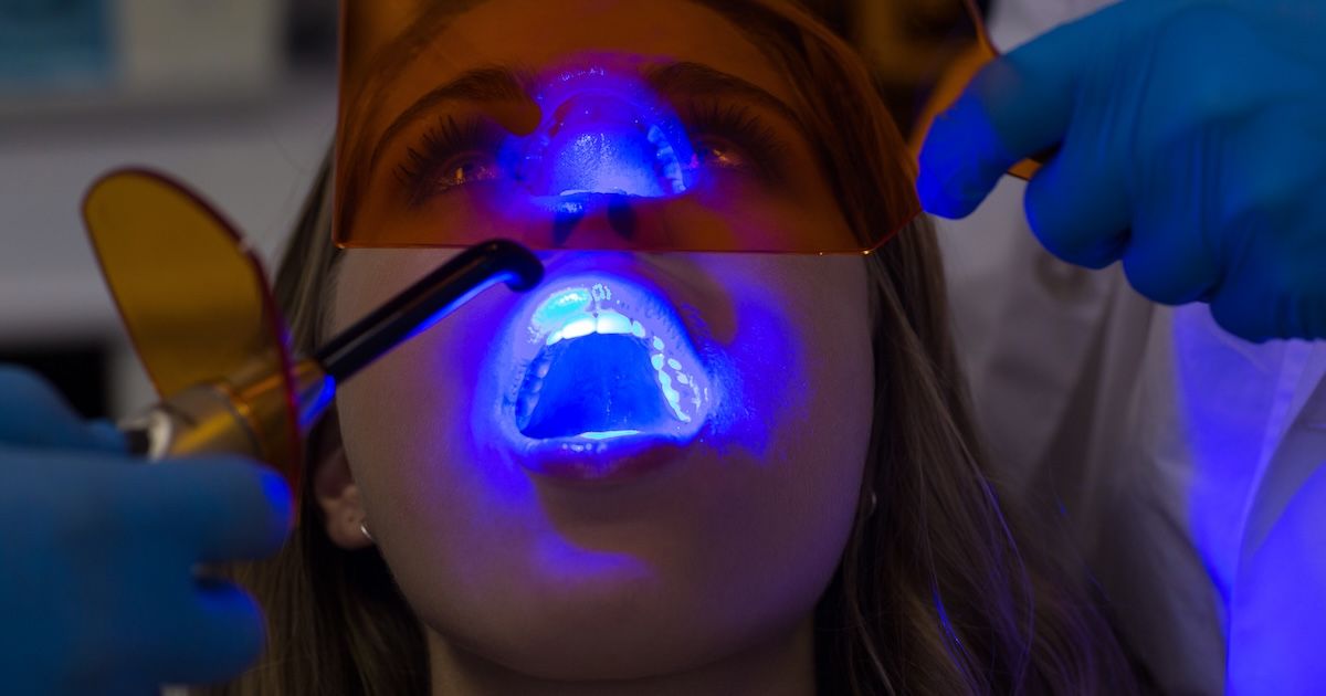 Vrouw die een LED-tandenbleekbehandeling ondergaat in een Impress-kliniek.