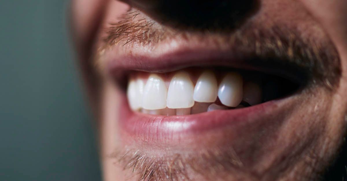 Patient smile showing dental crowding