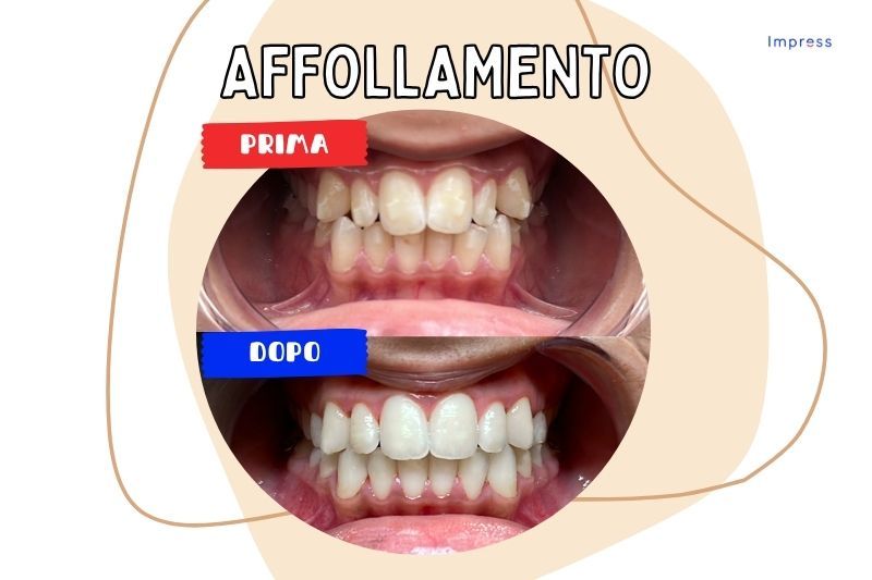 Caso di affollamento dentale risultato prima e dopo Impress