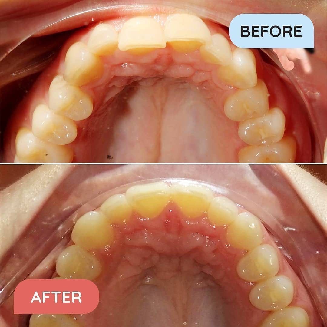 Affollamento dentale prima e dopo allineatori Impress