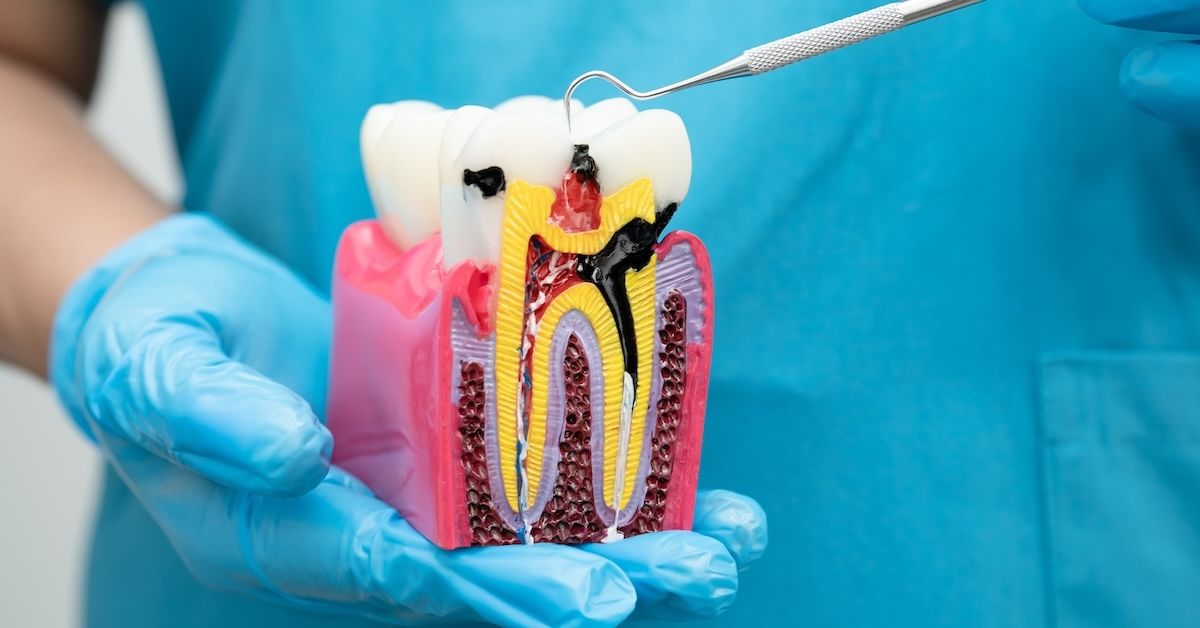 Dentist holding a model of a tooth with caries