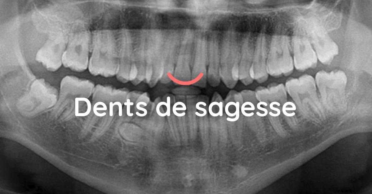 Dents de sagesse extraction avant appareil dentaire 🦷