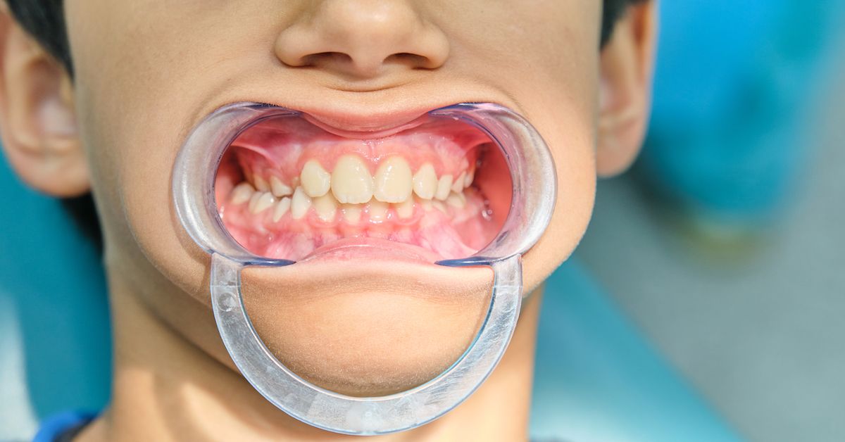 La boca de un niño con un abrebocas puesto.