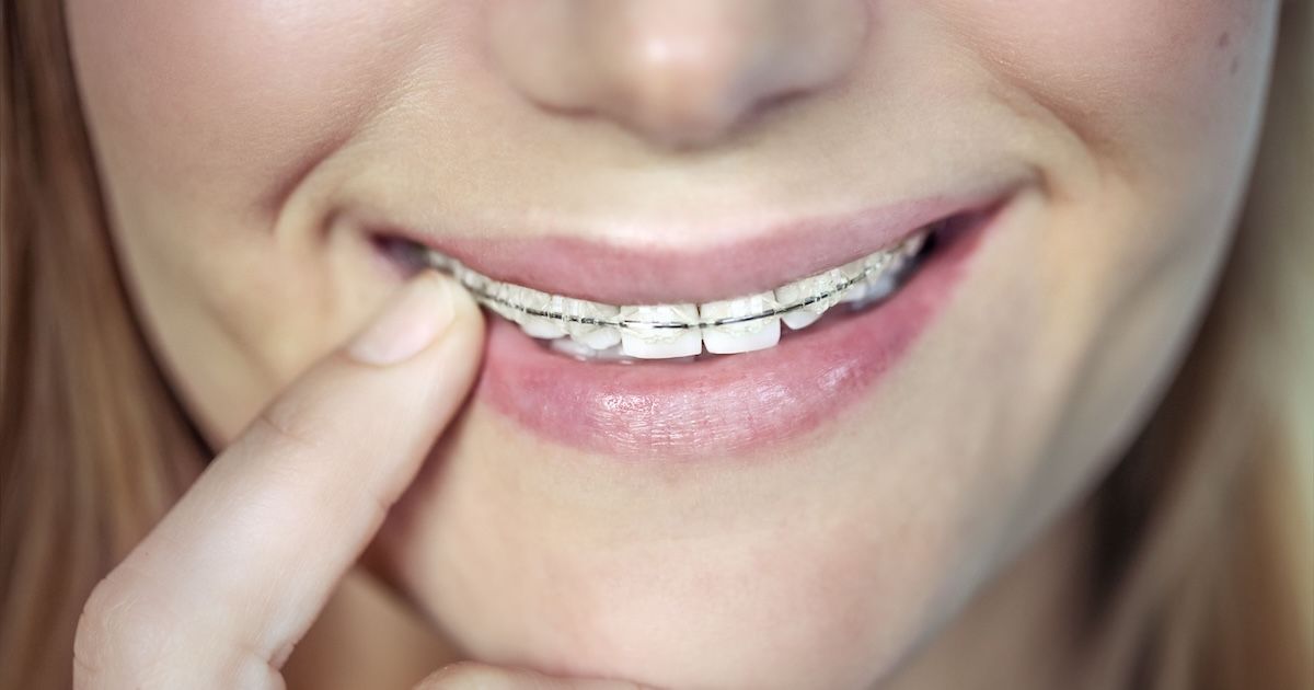 Dame die glimlacht en naar haar doorzichtige beugel wijst&nbsp;