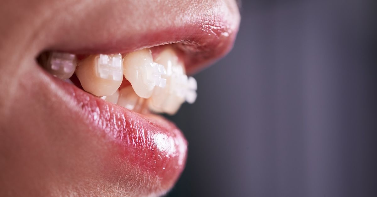 Dental attachments shown when woman smiles