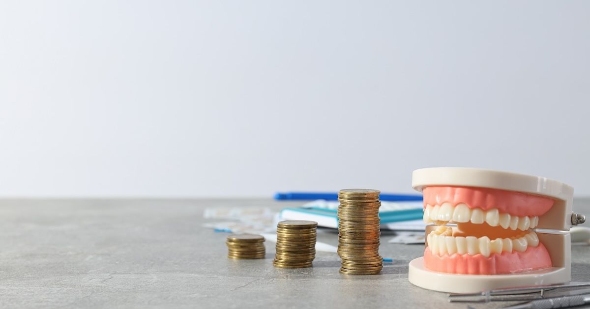 de kosten van onzichtbare beugels