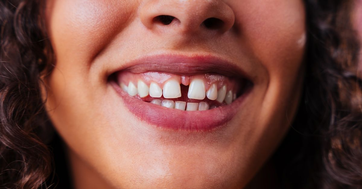 Smiling woman with a diastema