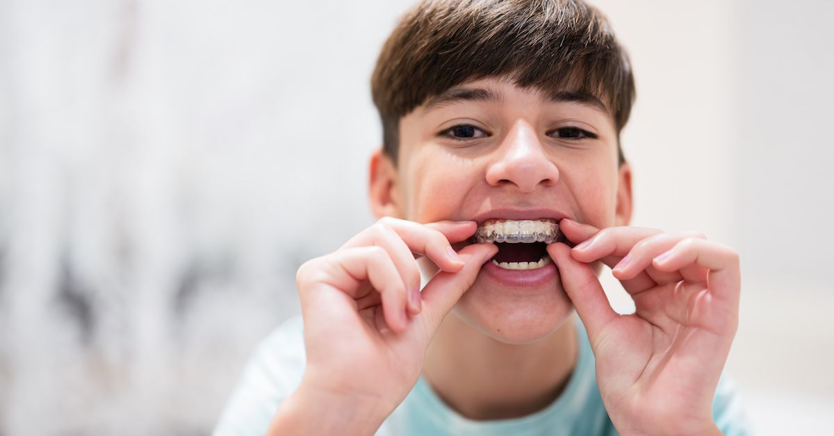 Un niño que se pone un alineador invisible con la mano en la arcada superior de los dientes.