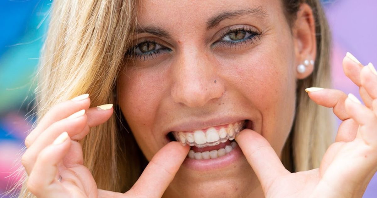 Een vrouw die haar doorzichtige aligners inbrengt.