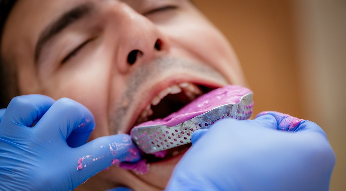 Gebitsafdruk voor een splint