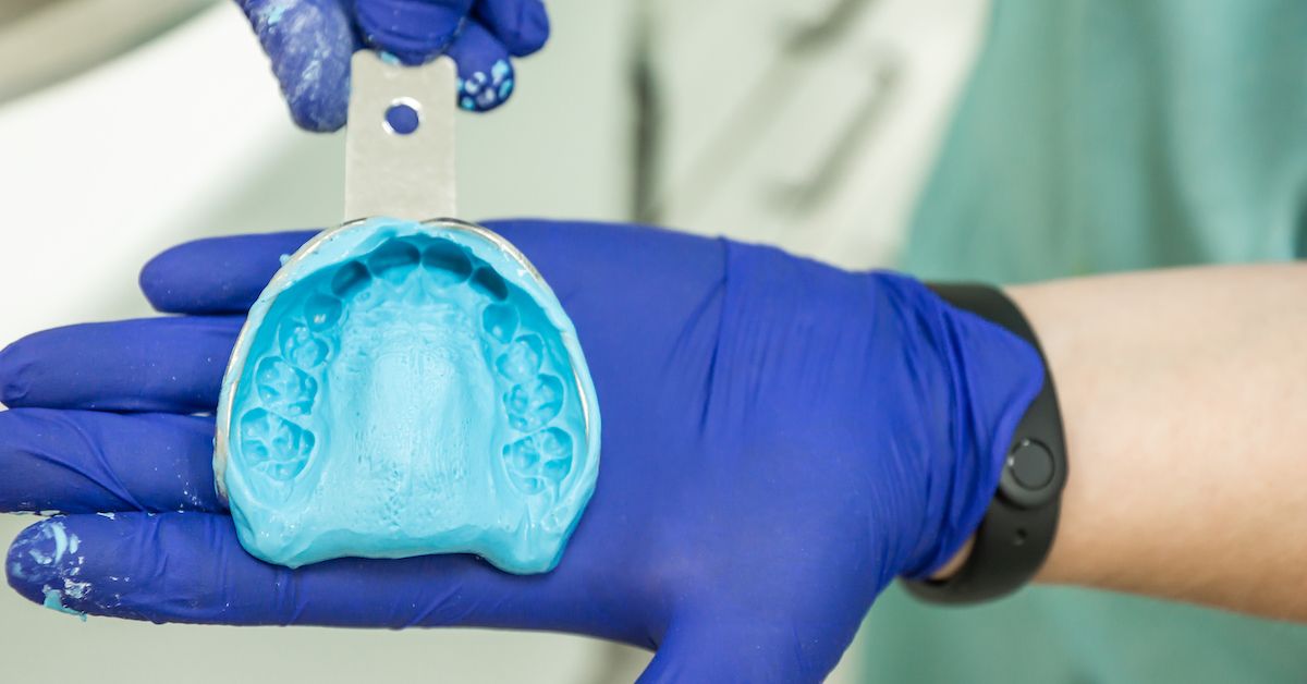 Una mano che sostiene uno stampo blu di un'impronta dentale già realizzata.