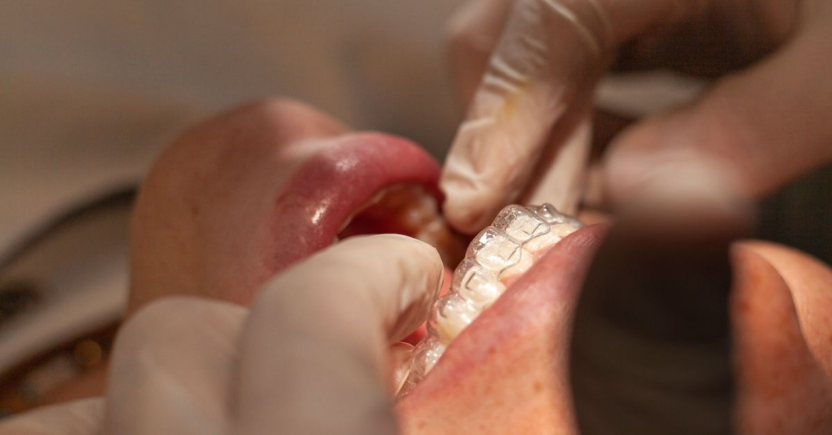 Patient getting retainers fitted