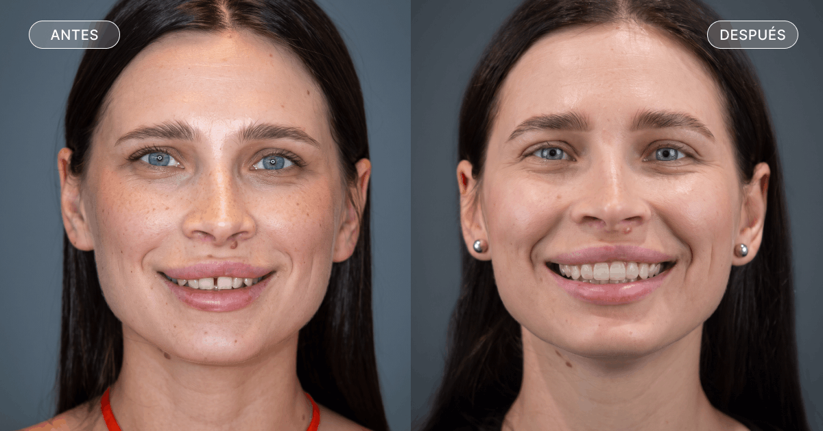 Antes y después de usar ortodoncia para cerrar los diastemas en los dientes.