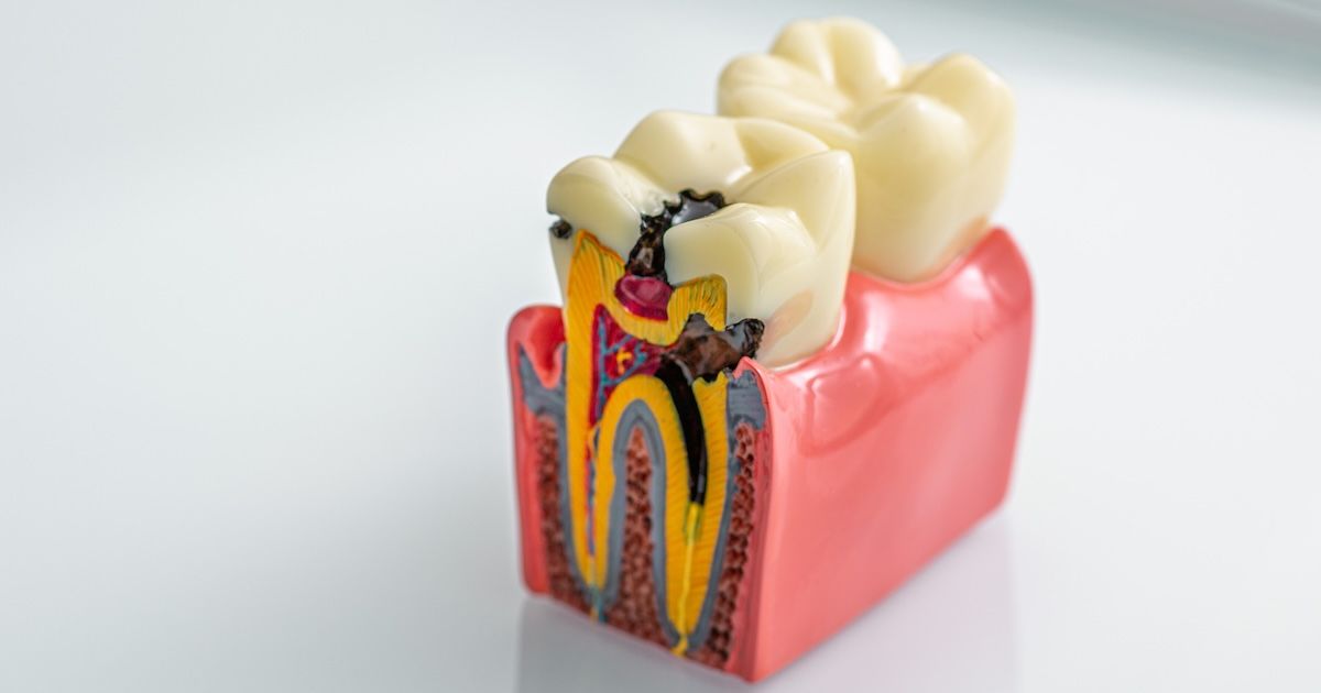 Een foto van een tand met caries