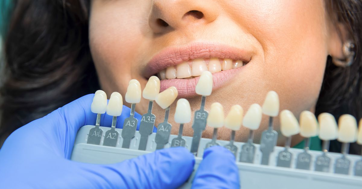 Blanqueamiento dental Tipos, precios e indicaciones 🦷