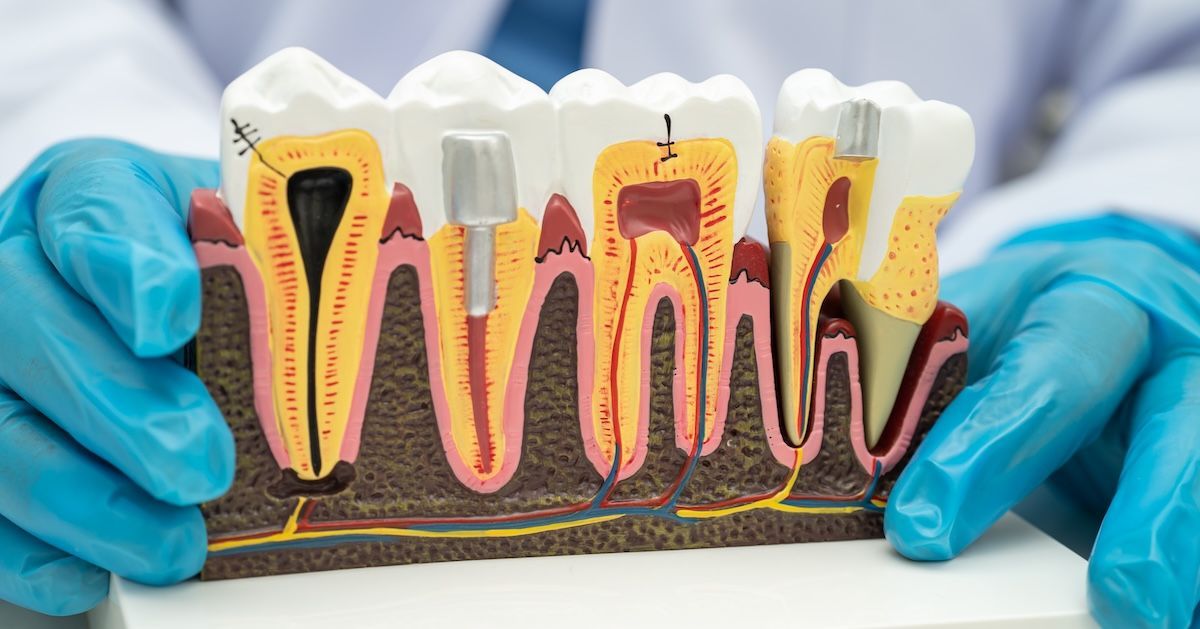 Een foto waar je ziet dat het beter is om een tand te trekken 