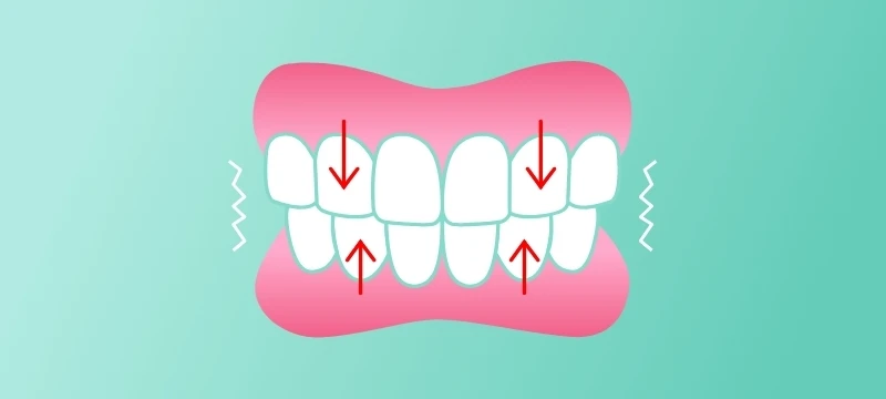 Grafik zeigt wie die Zähne beim Zähneknirschen aufeinanderpressen und für Reibung sorgen