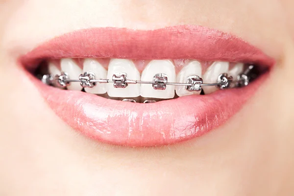 feste Zahnspange mit Metall Brackets auf den Zähnen im Oberkiefer