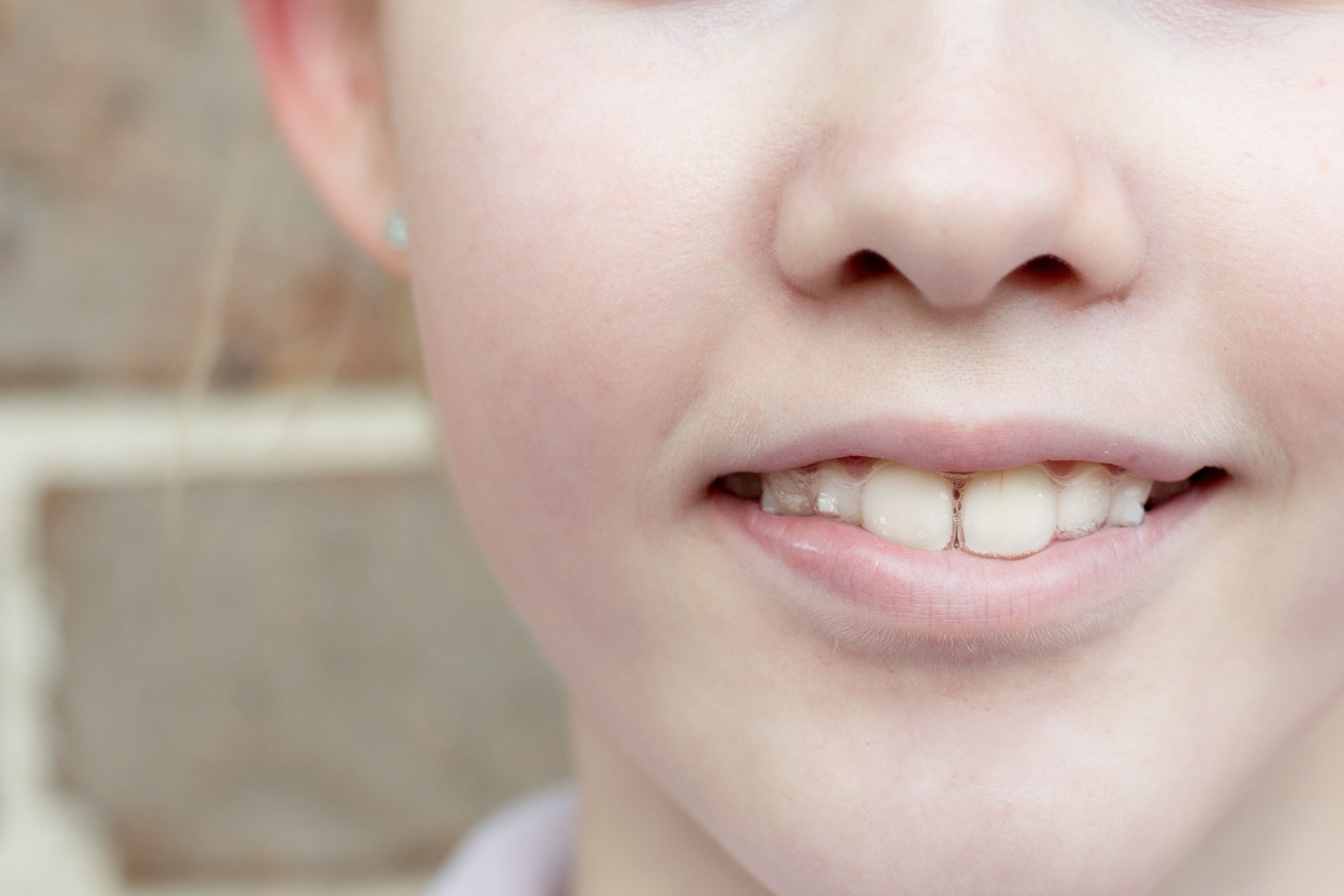 meisjes lach met aligners in haar mond waar je attachments kunt zien