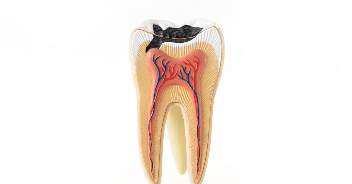 Tooth image with a carie developing