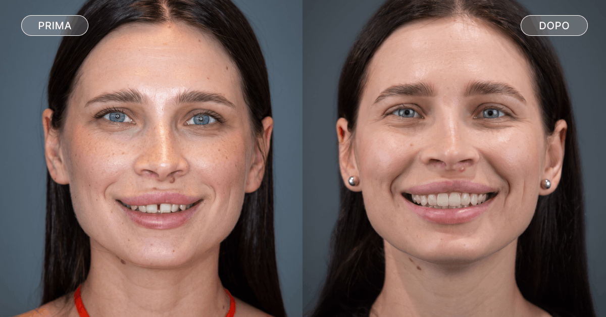 Prima e dopo il trattamento di ortodonzia per correggere il diastema dentale.