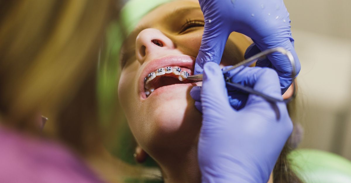Dentist fitting braces to the teeth of young woman