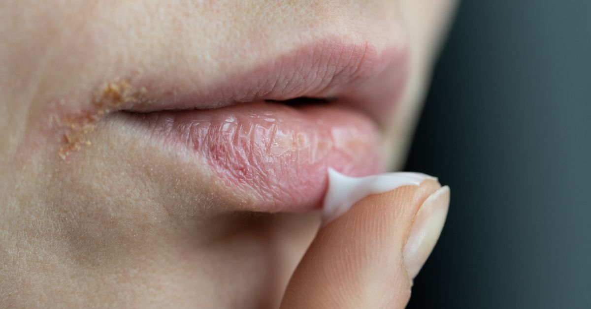 Una boca con una boquera y un dedo con crema para aplicarla.